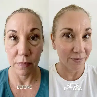 Before and After 1