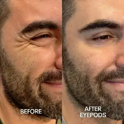 Before and After 2